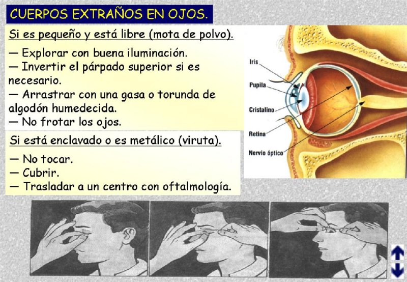 OBJETOS EXTRAOS EN OJOS