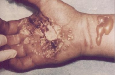 LESION  IMAGENES FOTOS